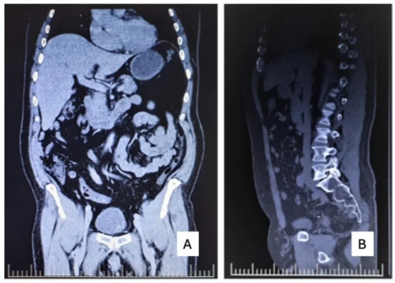 Mesane karsinoma in situ farkındalığı: yayımlanmış olgu görüntüsü, koronal+sagittal kesit