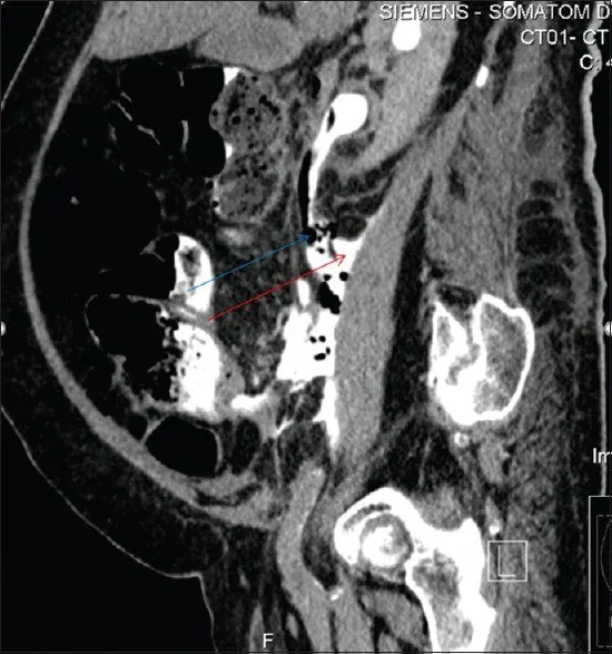 Üreter yaralanması ve idrar kaçağı: yayımlanmış olgu görüntüsü, sagittal kesit