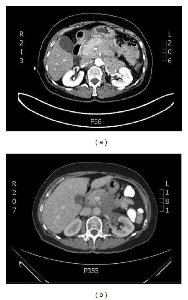 Retroperitoneal lenfoma: yayımlanmış olgu görüntüsü, aksiyel kesit
