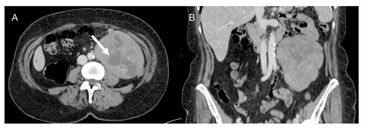 Diğer primer retroperitoneal sarkomlar: yayımlanmış olgu görüntüsü, aksiyel kesit