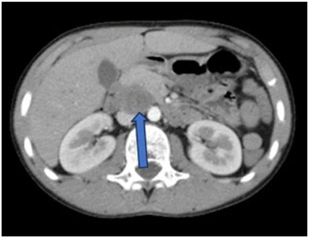 Testis tümöründe retroperitoneal nodal yayılım: yayımlanmış olgu görüntüsü, aksiyel kesit