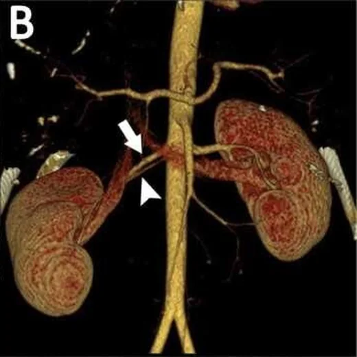 Aksesuar renal damarlar ve damar varyantları: yayımlanmış olgu görüntüsü, 3B kesit