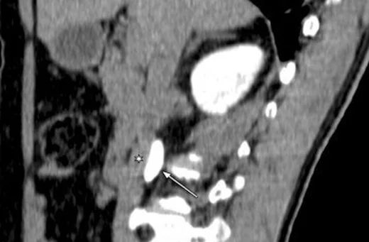 Ekstrarenal pelvis ve üreter seyir varyantları: yayımlanmış olgu görüntüsü, aksiyel kesit