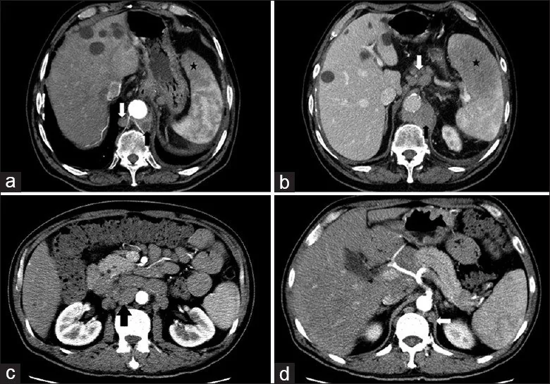 Retroperitoneal fibrozisin malign taklitçileri: yayımlanmış olgu görüntüsü, aksiyel kesit