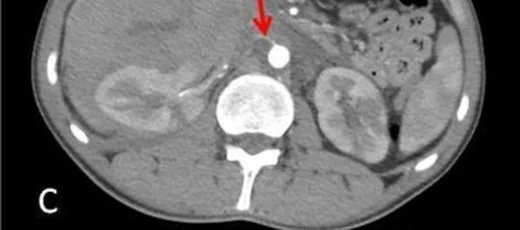 Renal arter anevrizması/psödoanevrizması ve rüptür: yayımlanmış olgu görüntüsü, aksiyel kesit