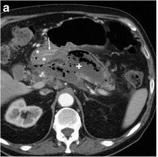 Retroperitoneal apse ve enfekte koleksiyon: yayımlanmış olgu görüntüsü, aksiyel kesit