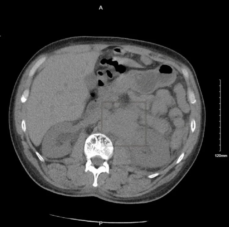Retroperitoneal ekstramedüller hematopoez: yayımlanmış olgu görüntüsü, aksiyel kesit