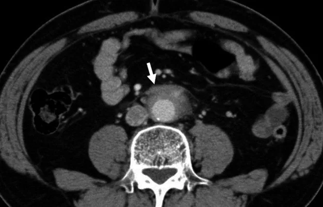 İdiyopatik/IgG4 ilişkili retroperitoneal fibrozis: yayımlanmış olgu görüntüsü, aksiyel kesit