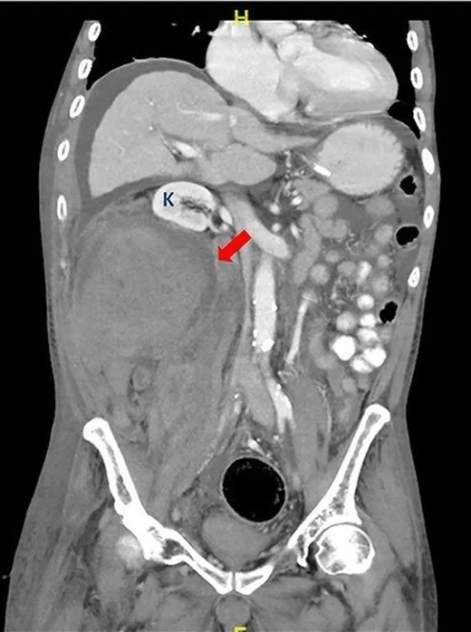 Retroperitoneal hematom: yayımlanmış olgu görüntüsü, koronal kesit
