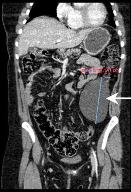 Primer retroperitoneal kistik lezyonlar ve kist taklitçileri: yayımlanmış olgu görüntüsü, aksiyel kesit