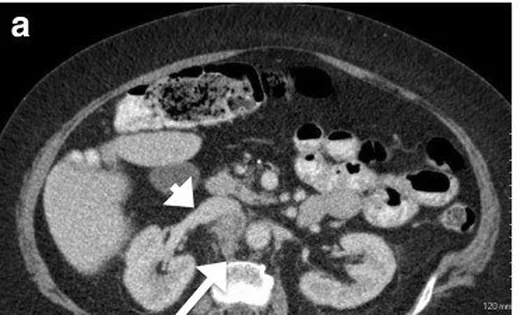Retroperitoneal leiomyosarkom: yayımlanmış olgu görüntüsü, aksiyel kesit