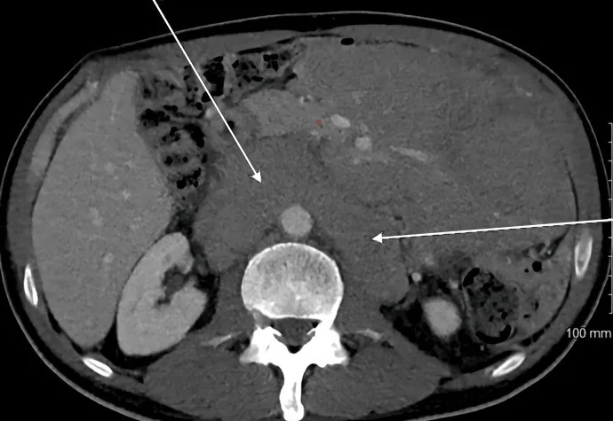Retroperitoneal lenfoma: yayımlanmış olgu görüntüsü, aksiyel kesit