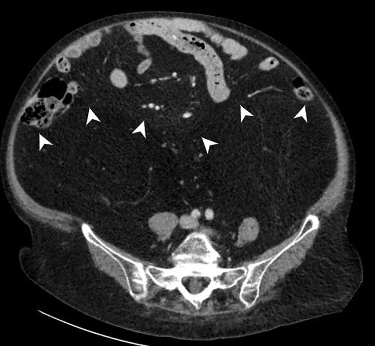 Retroperitoneal lipomatozis: yayımlanmış olgu görüntüsü, aksiyel kesit