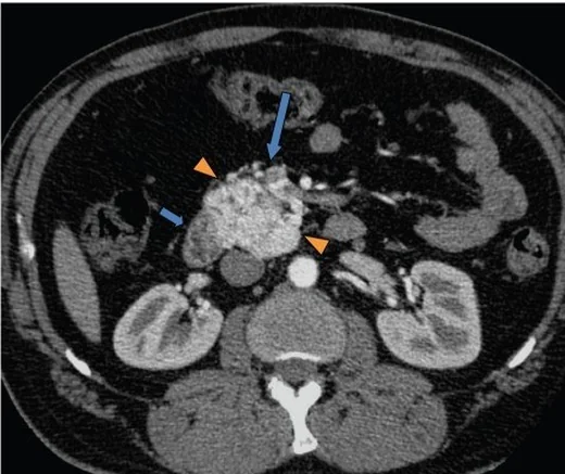Ekstraadrenal retroperitoneal paragangliom: yayımlanmış olgu görüntüsü, aksiyel kesit