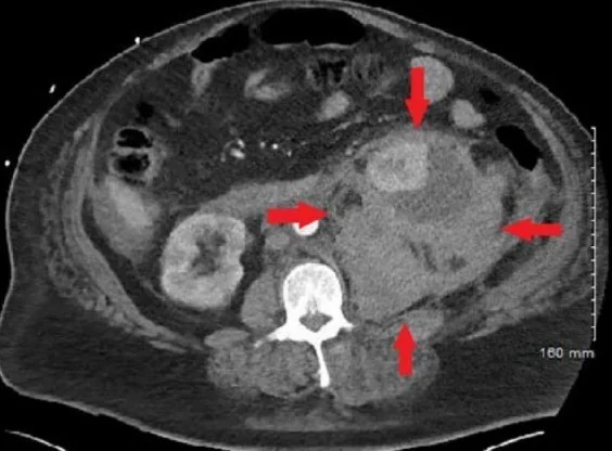 Spontan retroperitoneal kanama: yayımlanmış olgu görüntüsü, aksiyel kesit