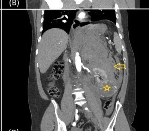Wunderlich sendromu: spontan perirenal kanama: yayımlanmış olgu görüntüsü, koronal kesit