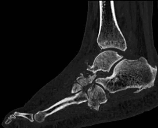 Charcot nöro-osteoartropatisi: yayımlanmış olgu görüntüsü, sagittal kesit