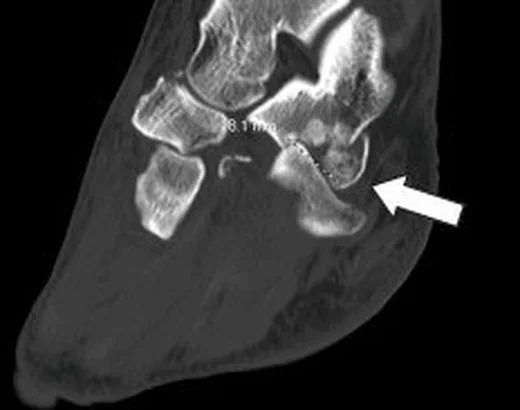Chopart eklem yaralanması: yayımlanmış olgu görüntüsü, sagittal kesit