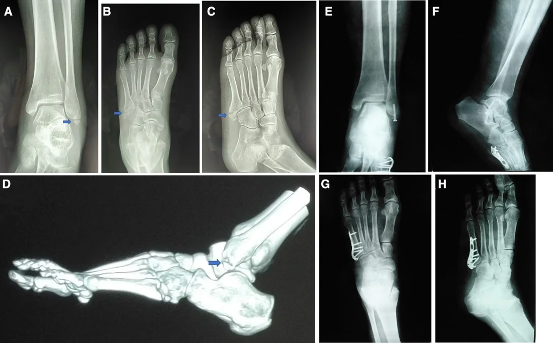 Beşinci metatars zonları ve Jones kırığı: yayımlanmış olgu görüntüsü, aksiyel kesit