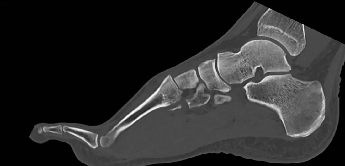 Lisfranc kompleksi yaralanması: yayımlanmış olgu görüntüsü, sagittal kesit