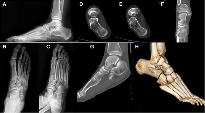 Naviküler kemik kırığı: yayımlanmış olgu görüntüsü, sagittal kesit