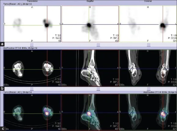Posterior talar fragman: os trigonum-kırık ayrımı: yayımlanmış olgu görüntüsü, sagittal kesit
