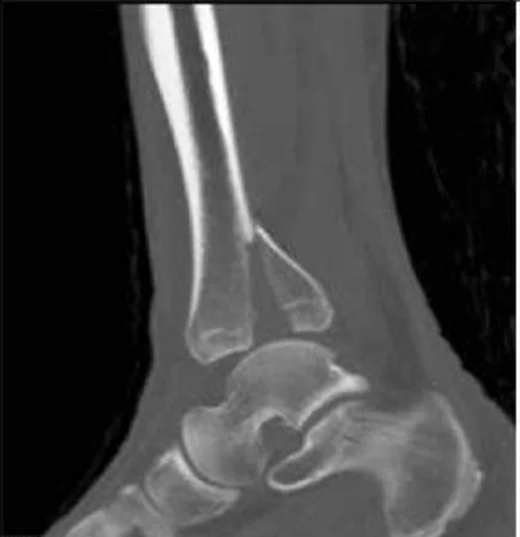Posterior malleol kırığı: yayımlanmış olgu görüntüsü, sagittal kesit
