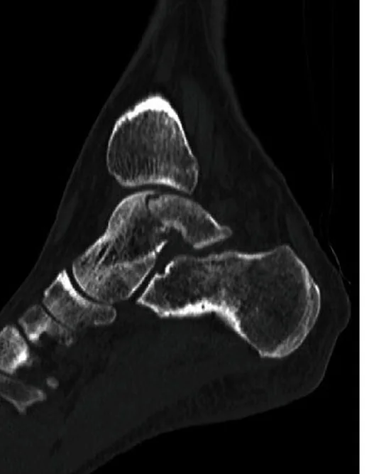 Talus gövde kırığı: yayımlanmış olgu görüntüsü, sagittal kesit