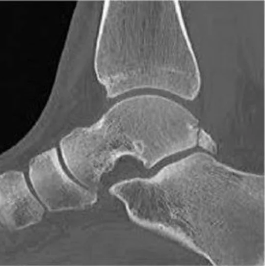 Talus proses kırıkları: yayımlanmış olgu görüntüsü, sagittal kesit
