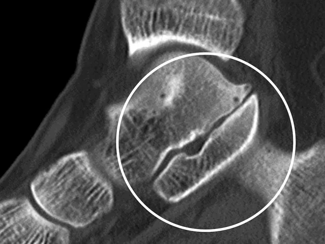 Tarsal koalisyon: yayımlanmış olgu görüntüsü, koronal kesit