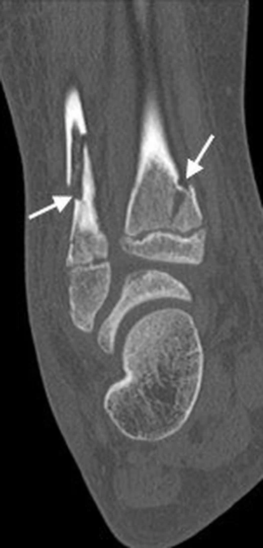 Triplan kırığı: yayımlanmış olgu görüntüsü, aksiyel+koronal+sagittal+3B kesit