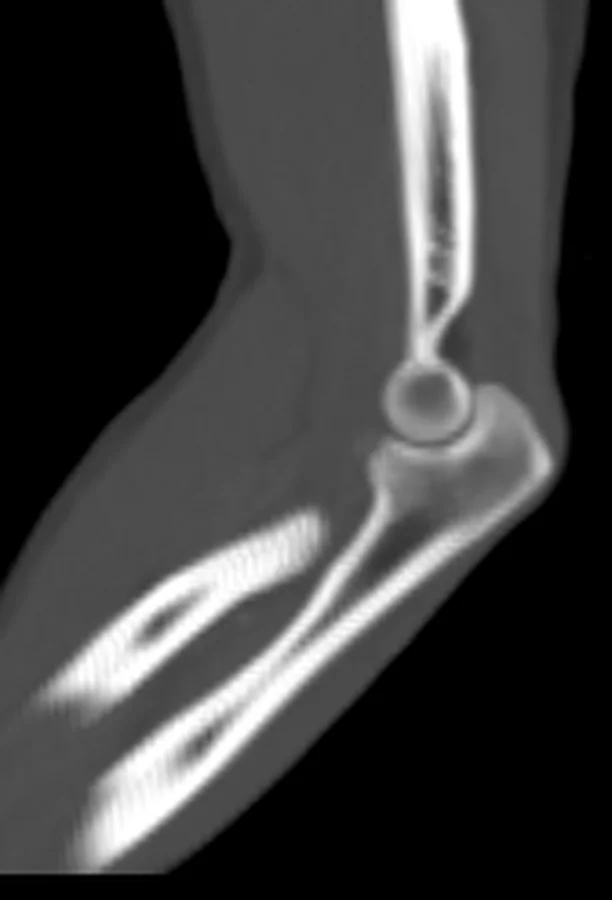 Bölge anatomisi (Dirsek), BT kesiti