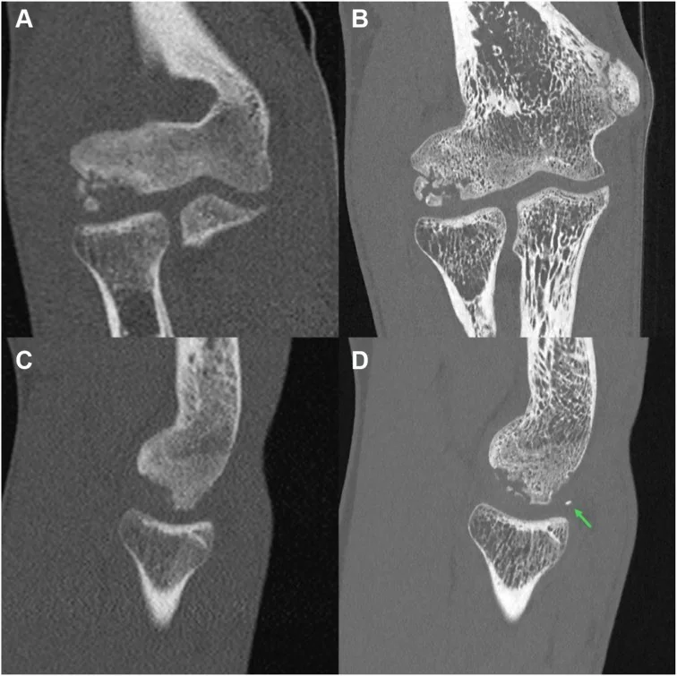 Kapitellum osteokondritis dissekansı: yayımlanmış olgu görüntüsü, sagittal kesit