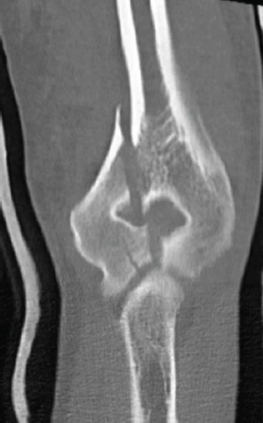Distal humerus interkondiler T/Y kırığı: yayımlanmış olgu görüntüsü, koronal kesit
