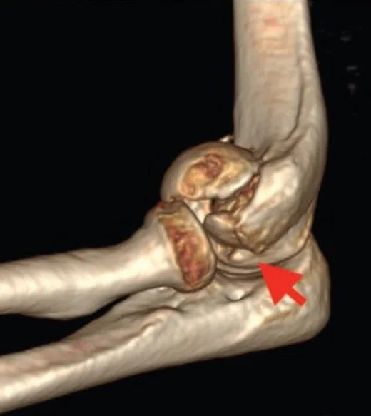 Kapitellum koronal kayma kırığı: yayımlanmış olgu görüntüsü, sagittal kesit