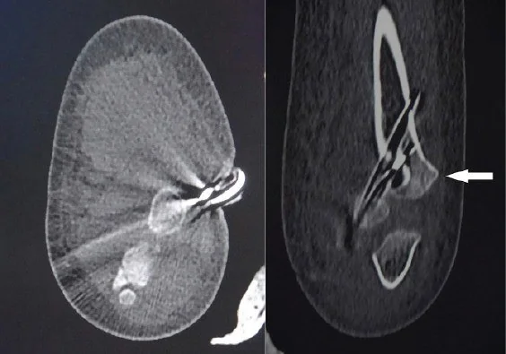 Pediatrik distal humerus fizis ayrışması: yayımlanmış olgu görüntüsü, aksiyel kesit