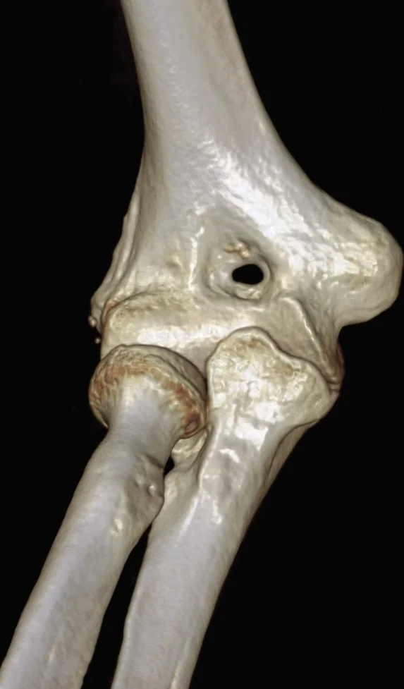Humerus olekranon açıklığı (supratroklear foramen): yayımlanmış olgu görüntüsü, 3B kesit