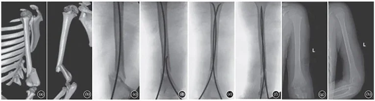Distal humerus suprakondiler kırığı: yayımlanmış olgu görüntüsü, 3B kesit
