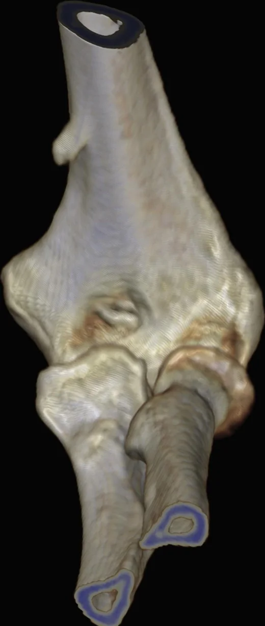 Humerus suprakondiler prosesi: yayımlanmış olgu görüntüsü, 3B kesit