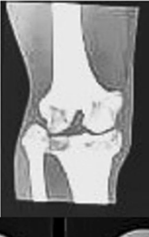 Distal femur eklem içi kırığı: yayımlanmış olgu görüntüsü, koronal kesit