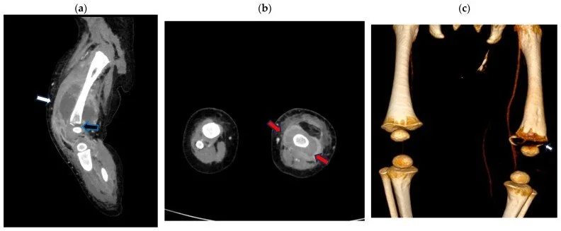 Diz çevresi osteomiyelit: yayımlanmış olgu görüntüsü, sagittal kesit