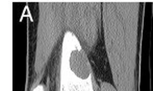 Non-ossifiye fibrom: yayımlanmış olgu görüntüsü, sagittal kesit