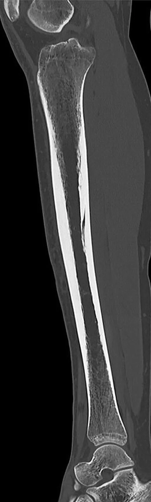 Tibia nutrient kanalı: yayımlanmış olgu görüntüsü, koronal kesit