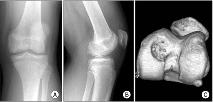 Diz osteokondritis dissekans: yayımlanmış olgu görüntüsü, 3B kesit