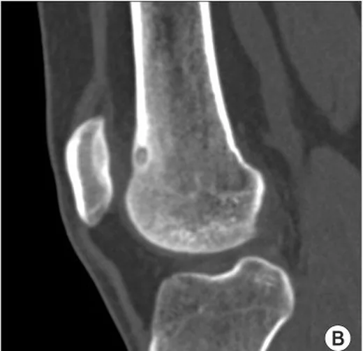 Diz çevresi osteoid osteom: yayımlanmış olgu görüntüsü, sagittal kesit