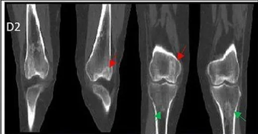Diz çevresi osteonekroz ve kemik enfarktı: yayımlanmış olgu görüntüsü, sagittal kesit