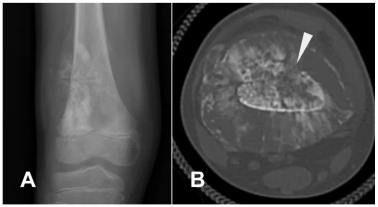 Diz çevresi osteosarkom: yayımlanmış olgu görüntüsü, aksiyel kesit