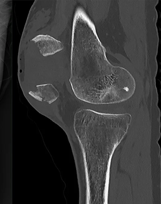Patella kırığı: yayımlanmış olgu görüntüsü, sagittal kesit