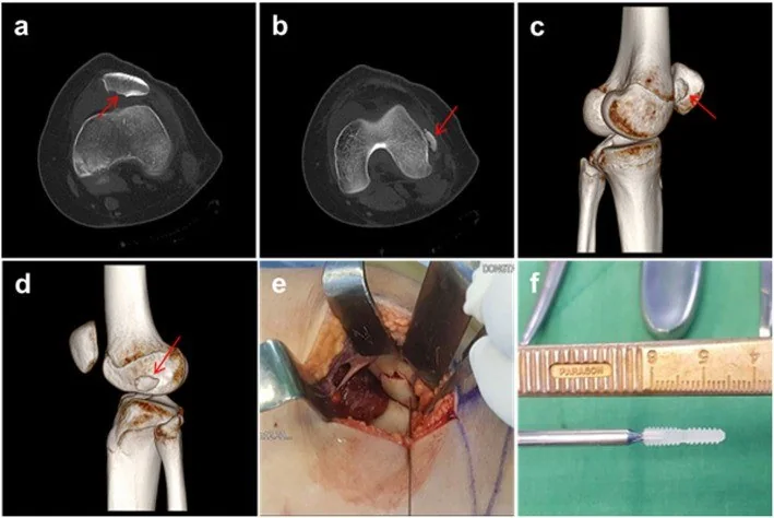 Patella çıkığı ve osteokondral kırık: yayımlanmış olgu görüntüsü, aksiyel kesit