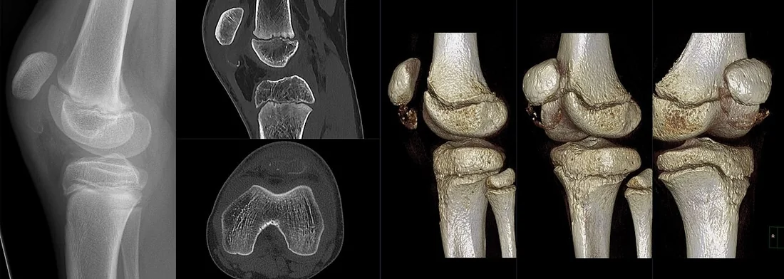Patellar kıkırdak kılıf avulsiyonu: yayımlanmış olgu görüntüsü, 3B kesit